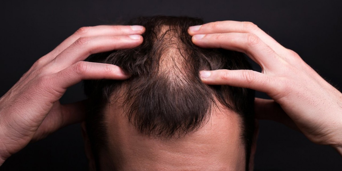 Yapay zekadan kellere müjde: Bu bantla saçlarınız yeniden çıkabilecek